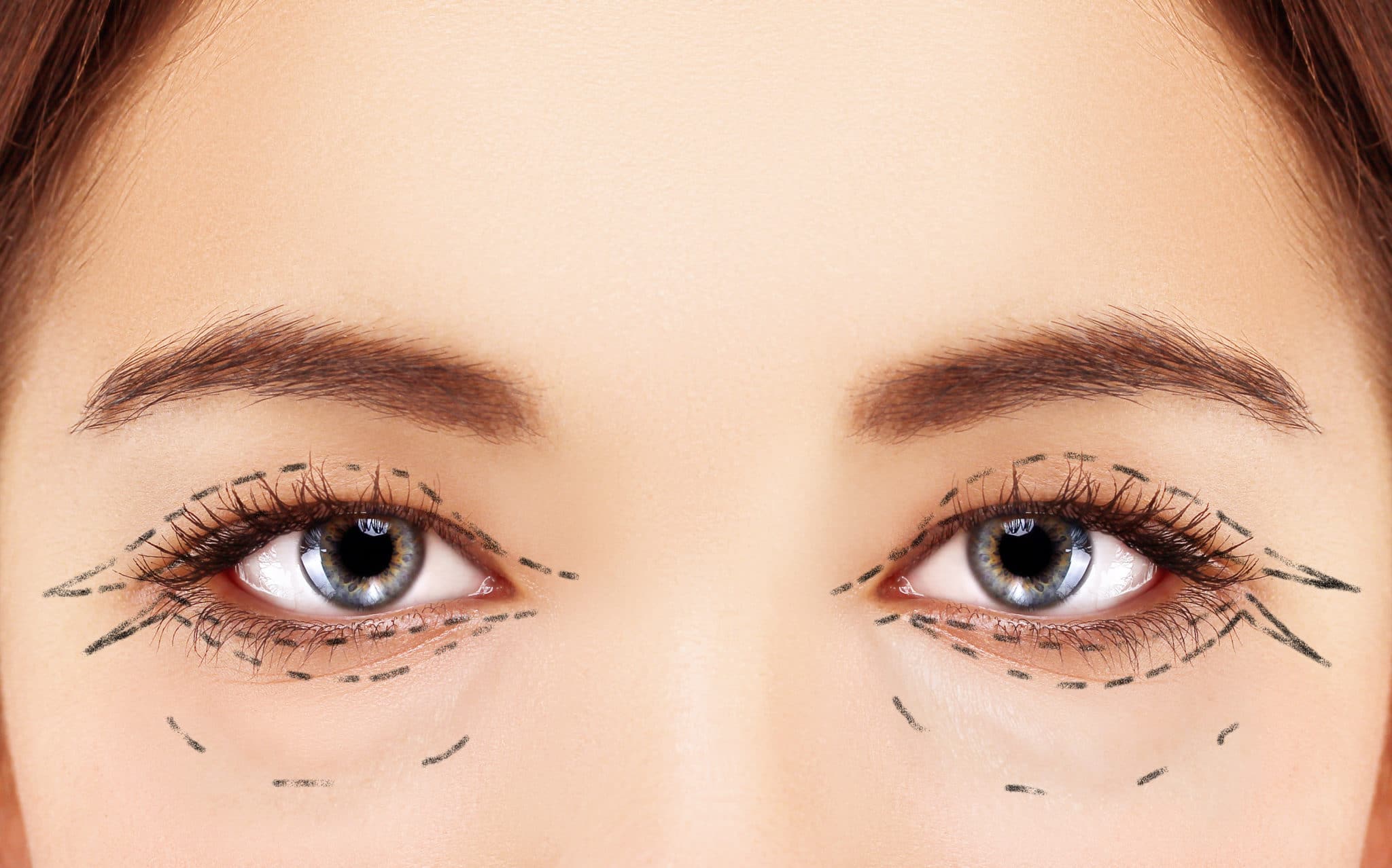 double eyelid surgery risks